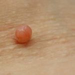 Fibrom / Skintag