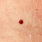 Körsbärsmärke / Cherry Spot